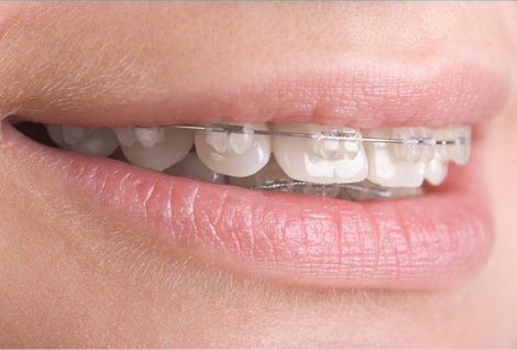 Detalle de ortodoncia con brackets estéticos